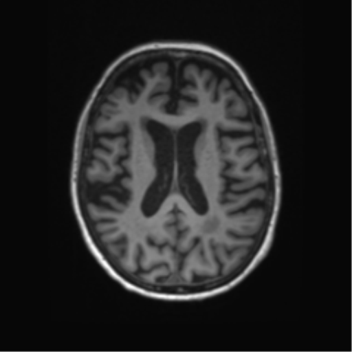 File:Alzheimer's disease (Radiopaedia 42658-45802 Axial T1 67).png
