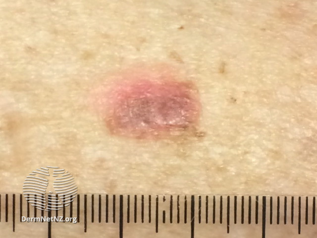 File:Amelanotic melanoma (DermNet NZ amelanotic-melanoma-022).jpg