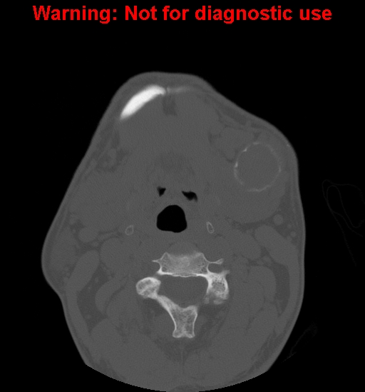 File:Ameloblastoma (Radiopaedia 13276-13280 Axial non-contrast 5).jpg