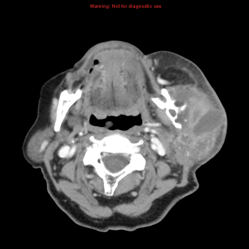 Ameloblastoma (Radiopaedia 27437-27631 A 41).jpg