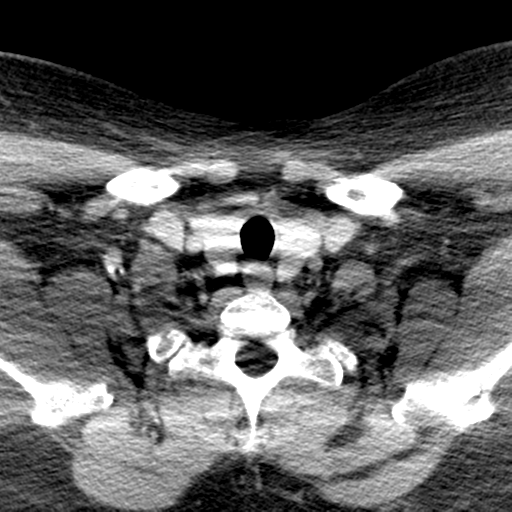 Ameloblastoma (Radiopaedia 38520-40623 Axial non-contrast 68).png