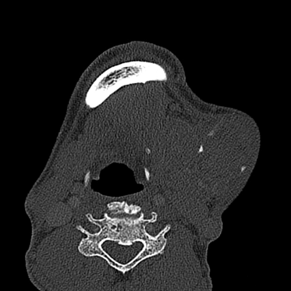 Ameloblastoma (Radiopaedia 51921-57766 Axial bone window 24).jpg
