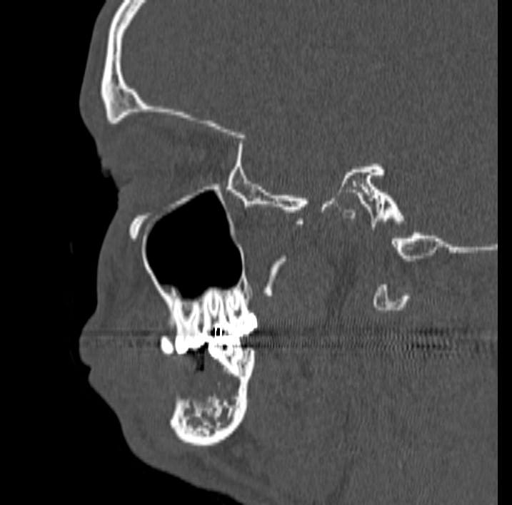 Ameloblastoma (Radiopaedia 77750-89997 Sagittal bone window 47).jpg