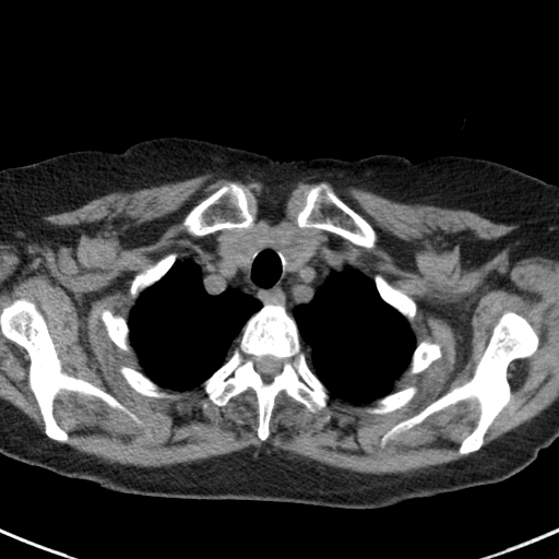File:Amiodarone-induced pulmonary fibrosis (Radiopaedia 82355-96460 Axial non-contrast 11).jpg