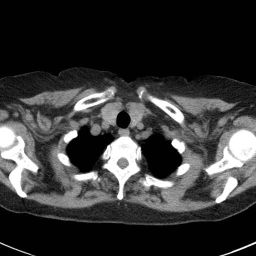 File:Amiodarone-induced pulmonary fibrosis (Radiopaedia 82355-96460 Axial non-contrast 9).jpg