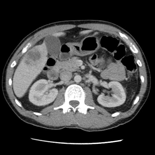Amoebic liver abscesses (Radiopaedia 55536-62009 A 37).jpg