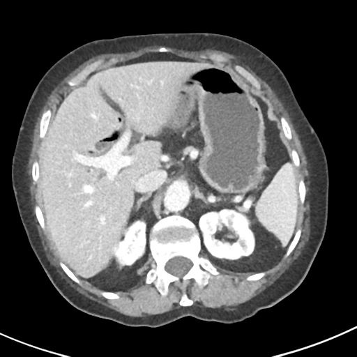 Ampullary adenocarcinoma (Radiopaedia 34013-35237 C 11).png