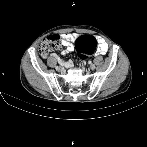 Ampullary adenocarcinoma (Radiopaedia 86093-102032 A 45).jpg
