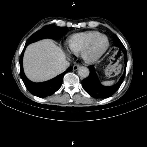 Ampullary adenocarcinoma (Radiopaedia 86093-102033 Axial C+ delayed 12).jpg