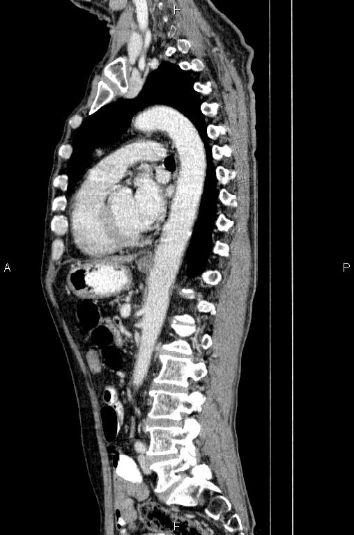 Ampullary adenocarcinoma (Radiopaedia 86093-102033 E 55).jpg