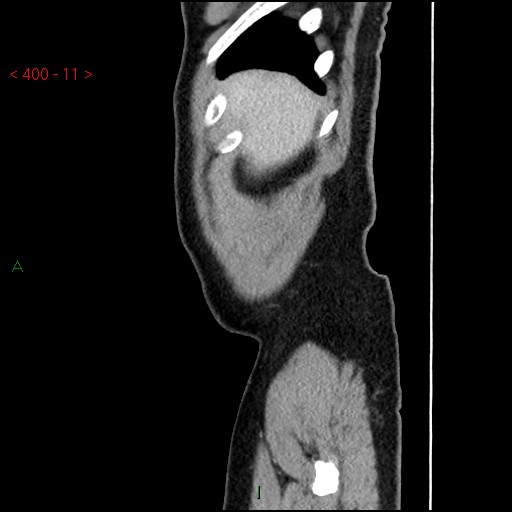Ampullary carcinoma (Radiopaedia 56396-63056 D 10).jpg