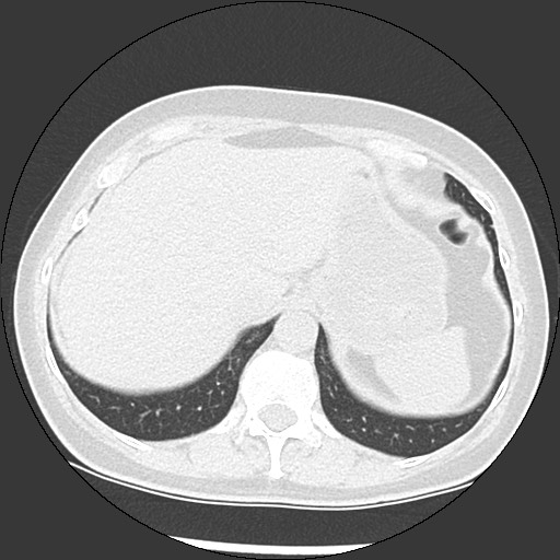 Amyloidosis - bronchial and diffuse nodular pulmonary involvement (Radiopaedia 60156-67744 B 51).jpg