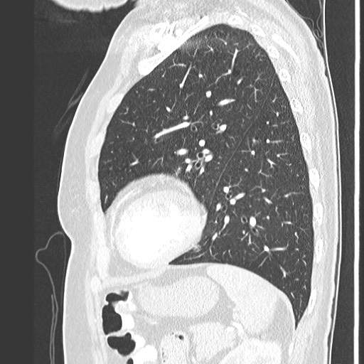 Amyloidosis - bronchial and diffuse nodular pulmonary involvement (Radiopaedia 60156-67745 Sagittal lung window 66).jpg