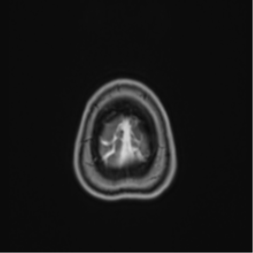 Anaplastic astroblastoma (Radiopaedia 55666-62194 Axial T1 C+ 71).png