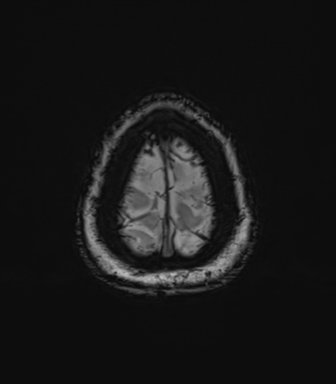 Anaplastic astrocytoma (Radiopaedia 86943-103160 Axial SWI 84).png
