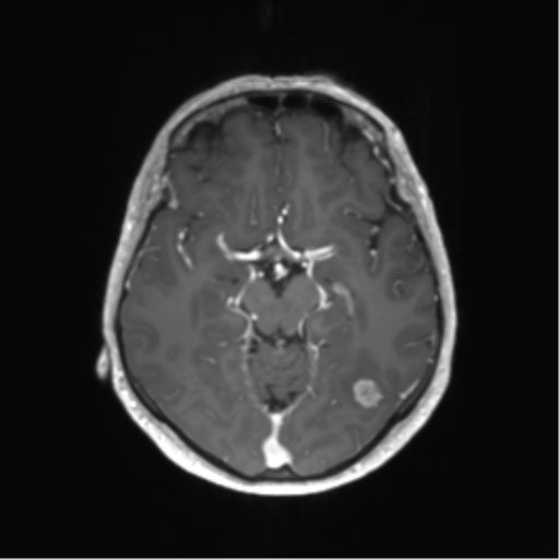 File:Anaplastic astrocytoma (Radiopaedia 86943-103160 Axial T1 C+ 15).png