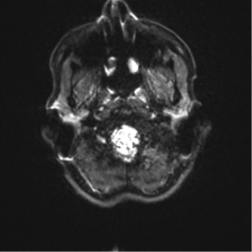 Anaplastic astrocytoma IDH mutant (Radiopaedia 50046-55341 Axial DWI 2).png
