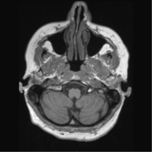 File:Anaplastic astrocytoma IDH wild-type (pseudoprogression) (Radiopaedia 42209-45276 Axial T1 27).png