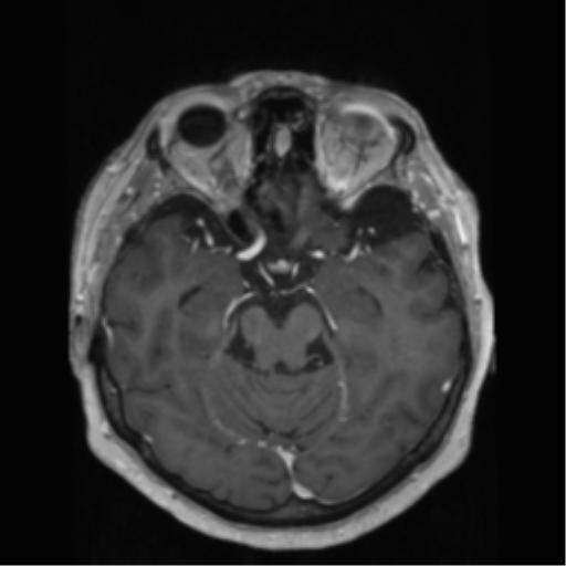 File:Anaplastic astrocytoma IDH wild-type (pseudoprogression) (Radiopaedia 42209-45278 Axial T1 C+ 64).png