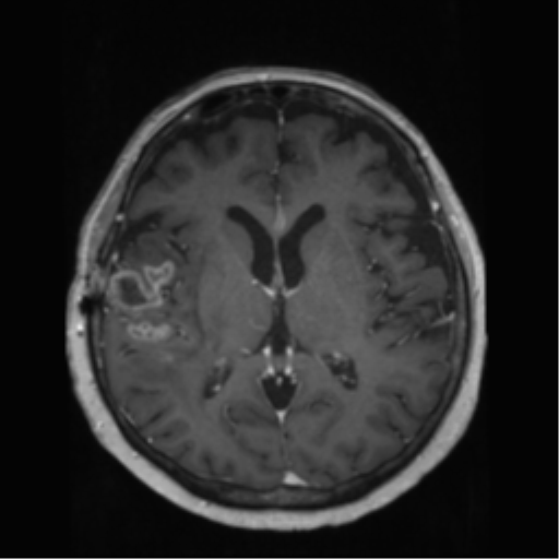 File:Anaplastic astrocytoma IDH wild-type (pseudoprogression) (Radiopaedia 42209-45278 Axial T1 C+ 86).png