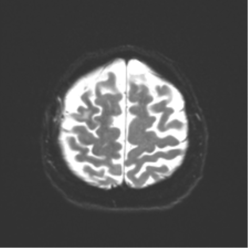 Anaplastic astrocytoma IDH wild-type (pseudoprogression) (Radiopaedia 42209-45279 Axial DWI 22).png
