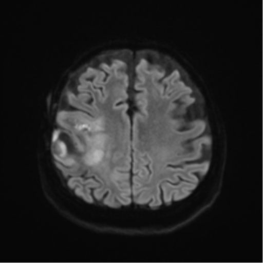 File:Anaplastic astrocytoma IDH wild-type (pseudoprogression) (Radiopaedia 42209-45279 Axial DWI 46).png