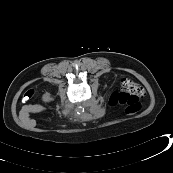 File:Anaplastic lymphoma - with CT biopsy (Radiopaedia 21643-21602 Axial non-contrast 42).jpg