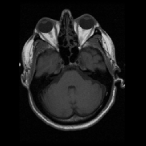 File:Anaplastic meningioma with recurrence (Radiopaedia 34452-35783 Axial T1 5).png