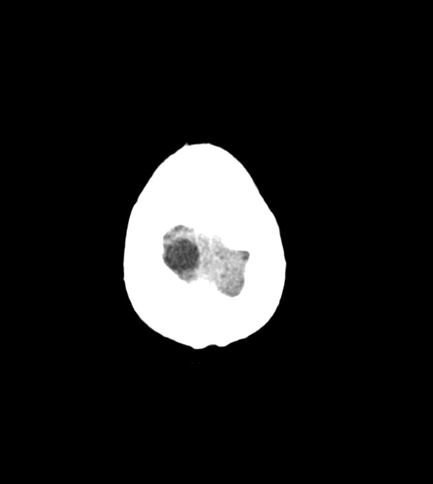 Anaplastic oligodendroglioma (Radiopaedia 79571-92758 Axial non-contrast 47).jpg