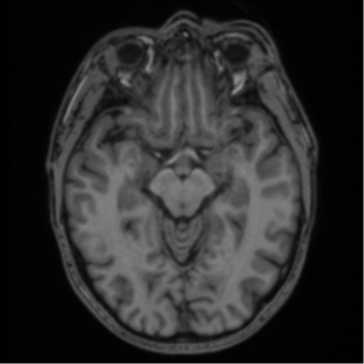 Anaplastic oligodendroglioma with skull fracture (Radiopaedia 74831-85845 Axial T1 25).png