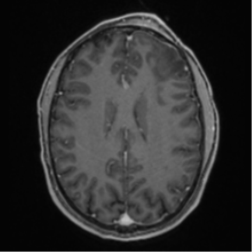Anaplastic oligodendroglioma with skull fracture (Radiopaedia 74831-85845 Axial T1 C+ fat sat 40).png