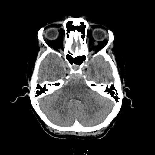 Aneursym related subarachnoid hemorrhage with hydrocephalus (Radiopaedia 45105-49083 Axial non-contrast 10).jpg