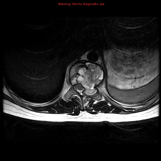File:Aneurysmal bone cyst (Radiopaedia 9419-10103 Axial T2 11).jpg