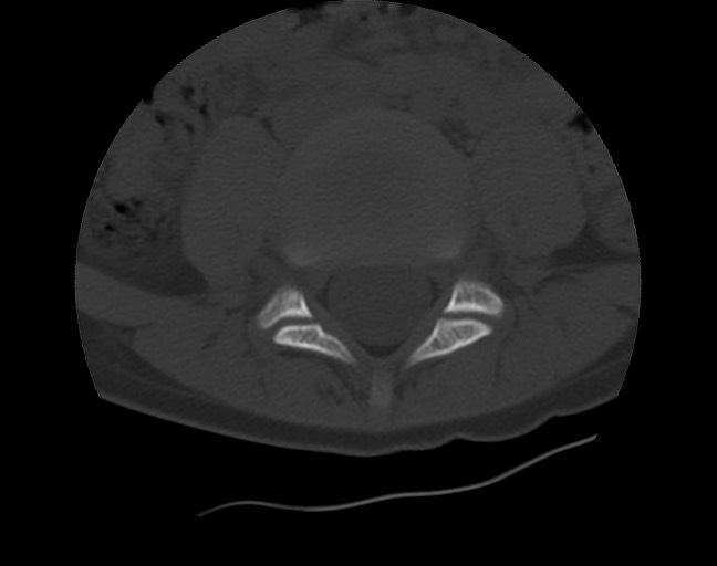 Aneurysmal bone cyst - sacrum (Radiopaedia 65190-74195 Axial bone window 5).jpg