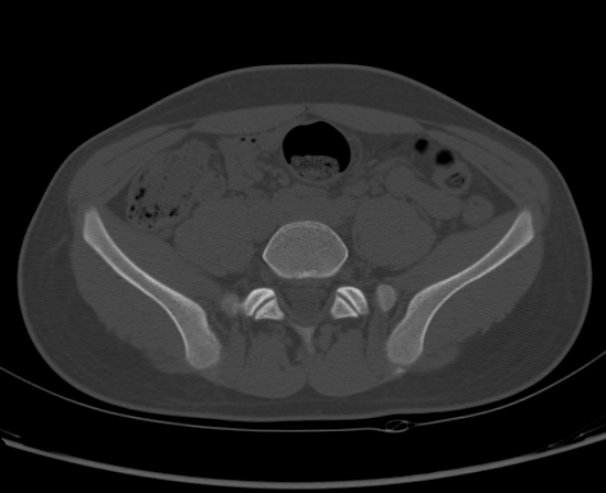 File:Aneurysmal bone cyst of ischium (Radiopaedia 25957-26094 Axial bone window 15).png