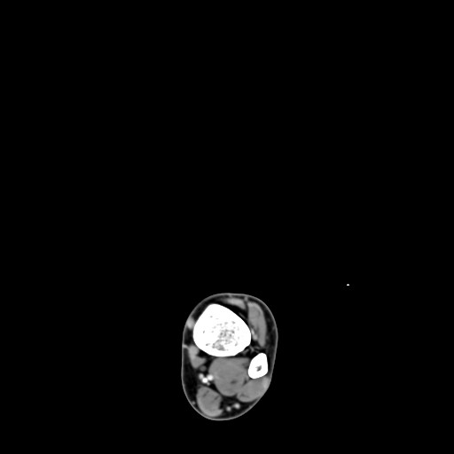 File:Aneurysmal bone cyst of the calcaneus (Radiopaedia 60669-68421 A 3).jpg
