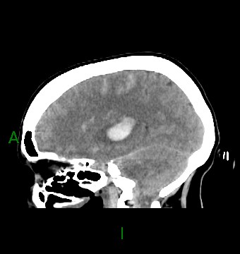 File:Aneurysmal subarachnoid hemorrhage with intra-axial extension (Radiopaedia 84371-99699 B 19).jpg