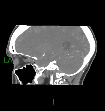 Aneurysmal subarachnoid hemorrhage with intra-axial extension (Radiopaedia 84371-99732 B 23).jpg