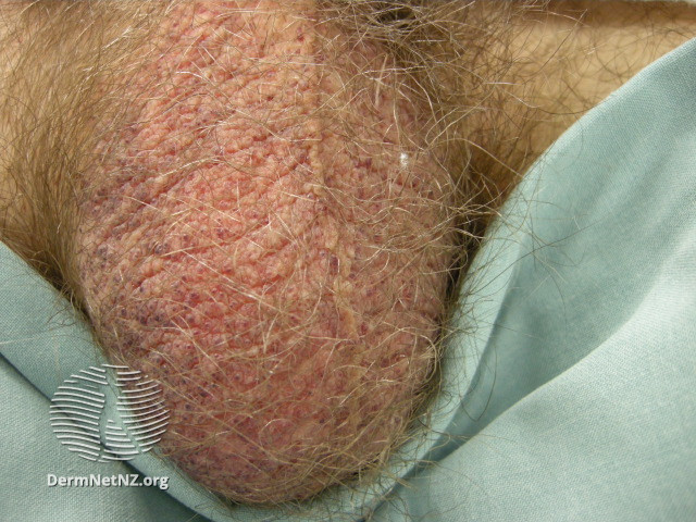File:Angiokeratoma of Fordyce on scrotum (DermNet NZ angiokeratoma-34).jpg