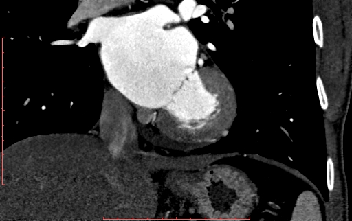 Anomalous left coronary artery from the pulmonary artery (ALCAPA) (Radiopaedia 70148-80181 B 193).jpg