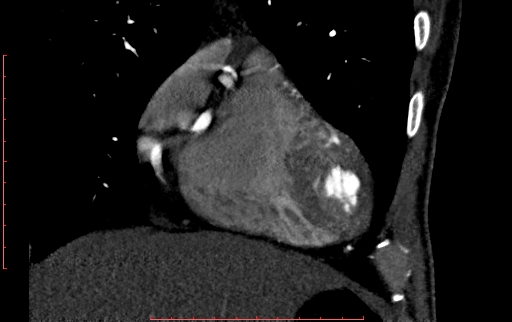 Anomalous left coronary artery from the pulmonary artery (ALCAPA) (Radiopaedia 70148-80181 B 69).jpg