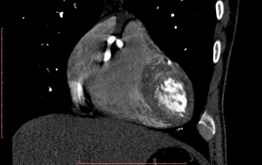 Anomalous left coronary artery from the pulmonary artery (ALCAPA) (Radiopaedia 70148-80181 B 78).jpg