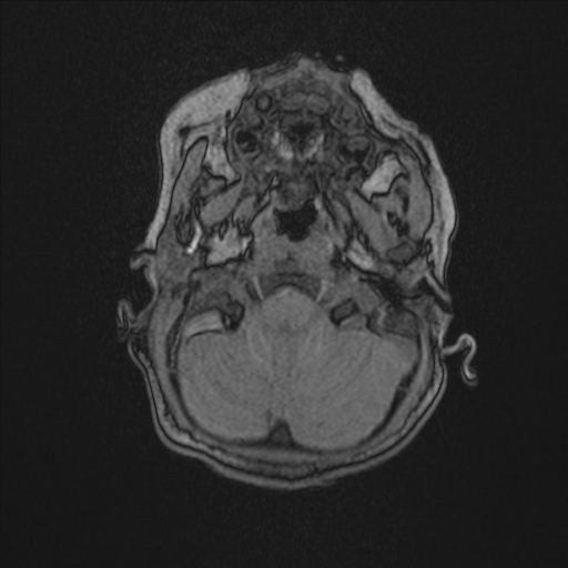 Anoxic brain injury (Radiopaedia 79165-92139 Axial MRA 31).jpg