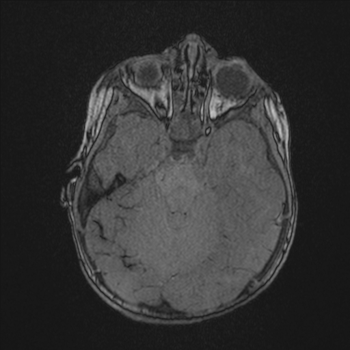 Anoxic brain injury (Radiopaedia 79165-92139 Axial MRA 72).jpg