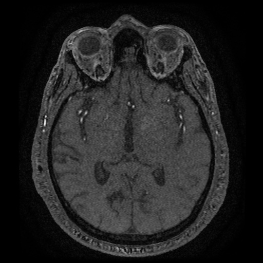 Anterior cerebral artery infarction (Radiopaedia 46794-51323 Axial MRA 100).jpg