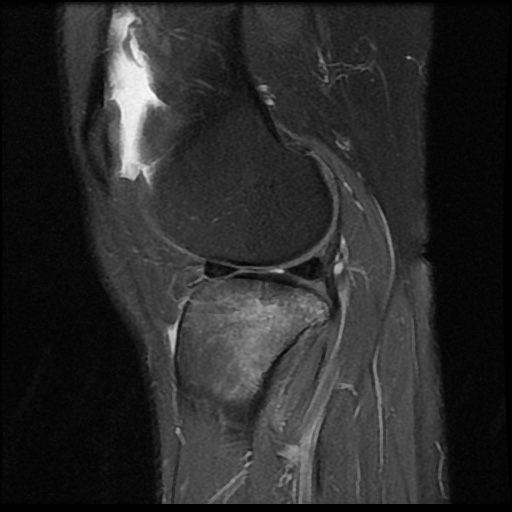 File:Anterior cruciate ligament avulsion fracture (Radiopaedia 58939-66193 Sagittal PD fat sat 7).jpg