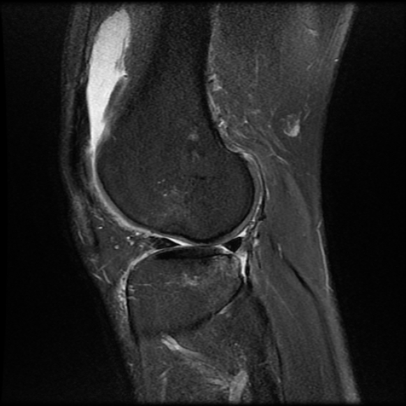 File:Anterior cruciate ligament graft tear and bucket-handle tear of medial meniscus (Radiopaedia 75867-87255 Sagittal PD fat sat 21).jpg