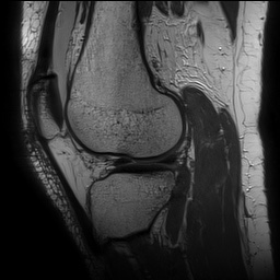 Anterior cruciate ligament rupture with Segond fracture (Radiopaedia 69043-78806 Sagittal PD 129).jpg