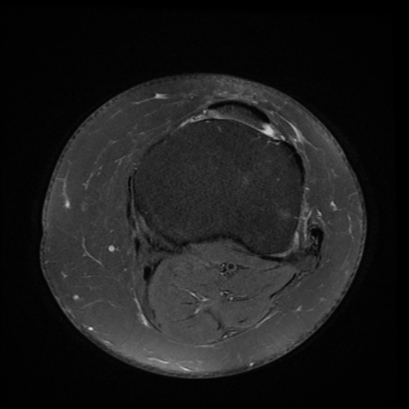 File:Anterior cruciate ligament tear, Wrisberg rip and bucket-handle tear of medial meniscus (Radiopaedia 75872-87266 Axial PD fat sat 5).jpg
