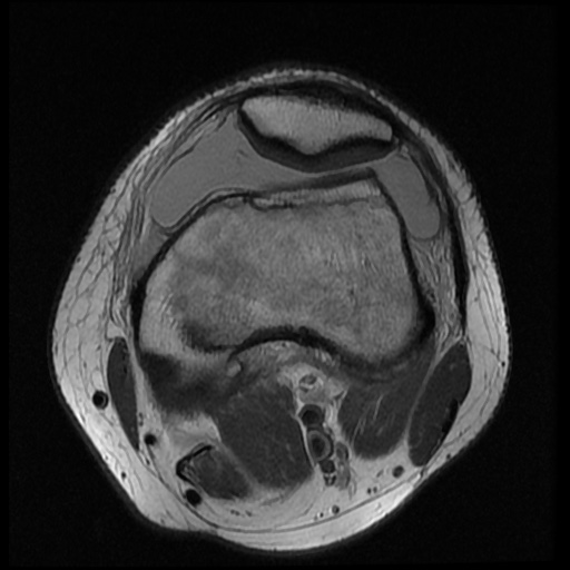 File:Anterior cruciate ligament tear (Radiopaedia 61500-69462 Axial PD 6).jpg